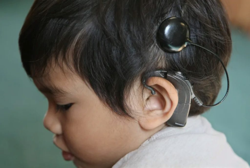 Cochlear Implants: As Miraculous As They Say?