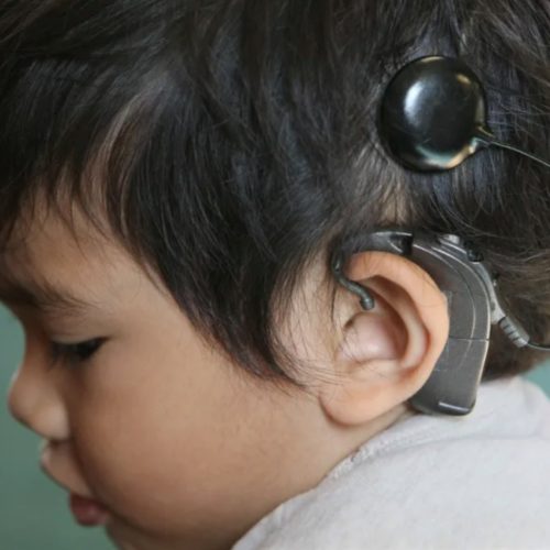 Cochlear Implants: As Miraculous As They Say?